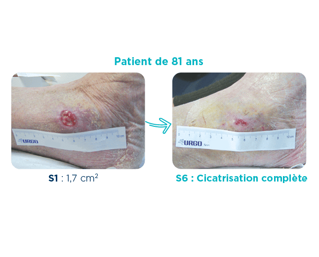 cas clinique d'un ulcère veineux sur un patient de 81 ans S1 : 1,7 cm2 S6 : Cicatrisation complète