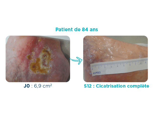 Plaie d'un ulcère veineux sur une patiente de 84 ans à J0 (6,9 cm2) et à S12 cicatrisation complète