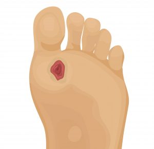 La plaie du pied diabétique - explication avec Urgo Medical