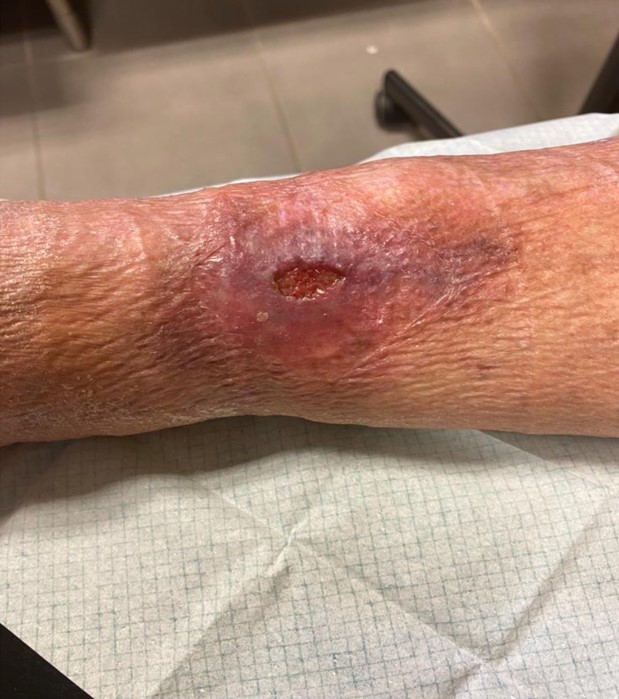 photographie ulcère de jambe veineux douloureux : cas clinique de Valérie B, IDEL