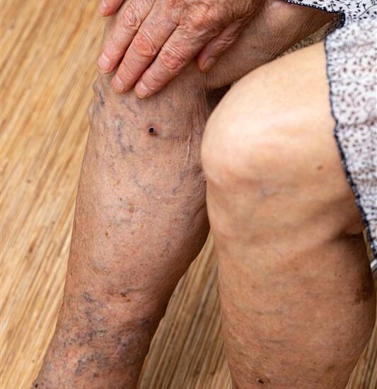 jambe avec insuffisance veineuse