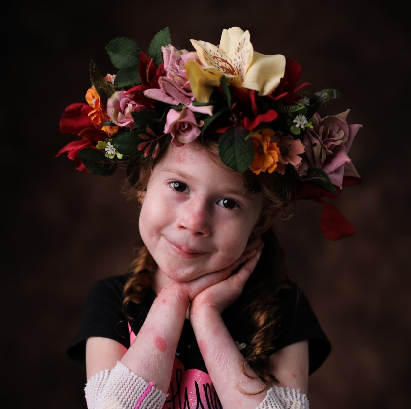 fillette présentant des plaies (épidermolyse bulleuse)