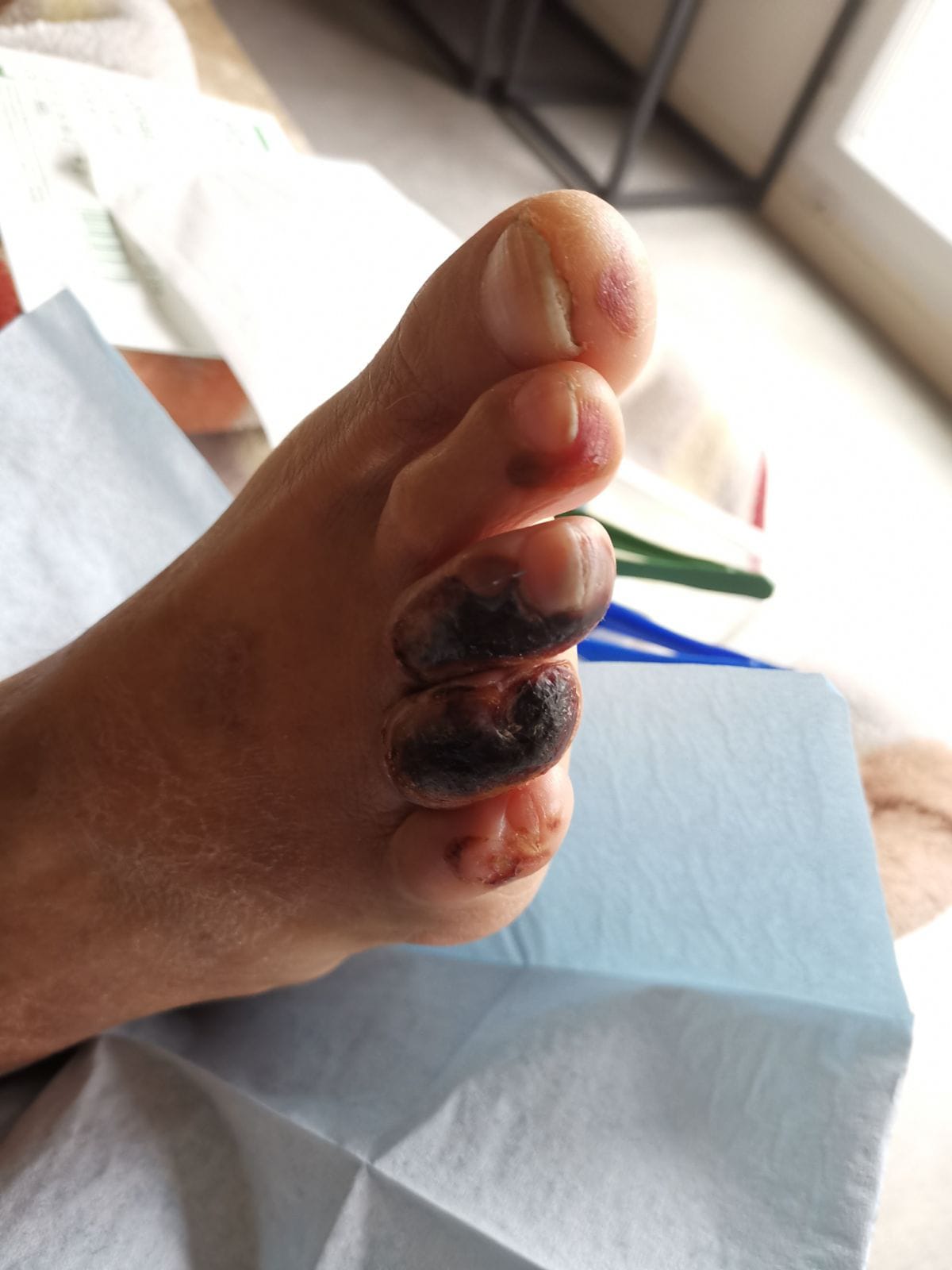 plaies aux orteils nécrosées