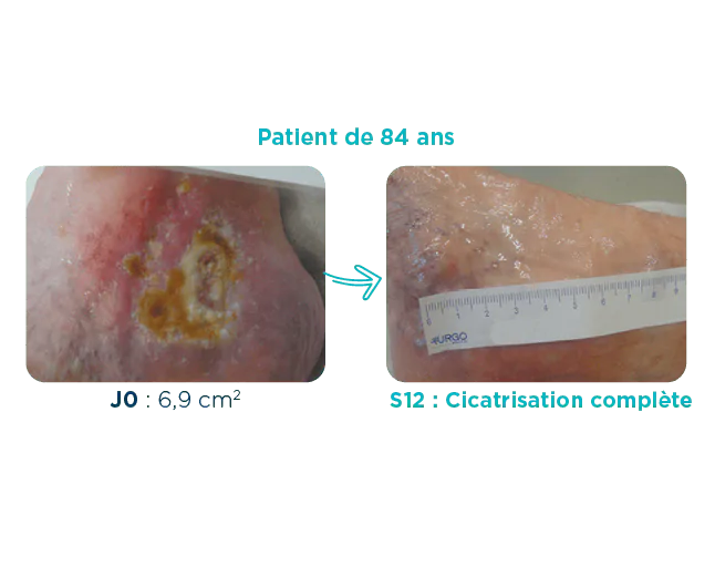 Plaie d'un ulcère veineux sur une patiente de 84 ans à J0 (6,9 cm2) et à S12 cicatrisation complète