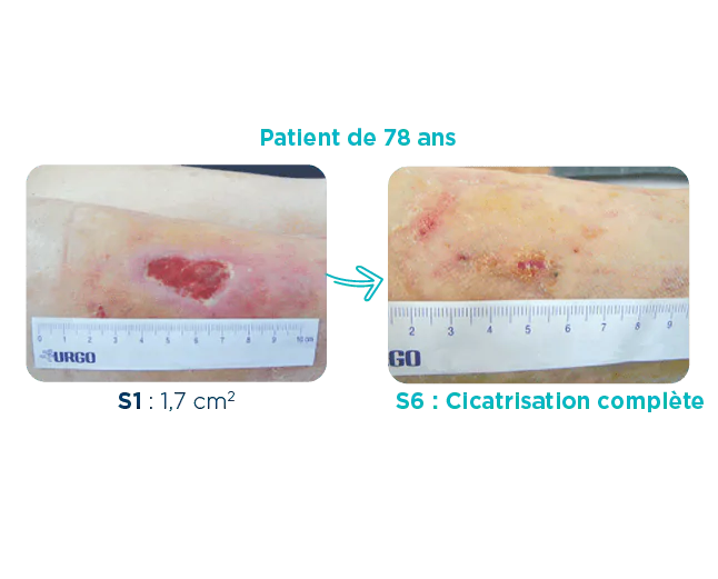 Cas clinique d'un patient de 78 ans présentant un ulcère veineux S1: 1,7cm2 S6: Cicatrisation complète