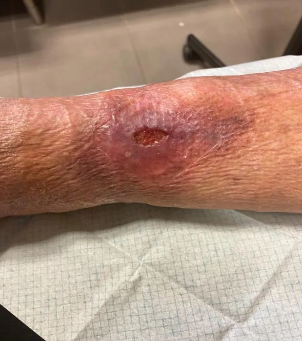 photographie ulcère de jambe veineux douloureux : cas clinique de Valérie B, IDEL