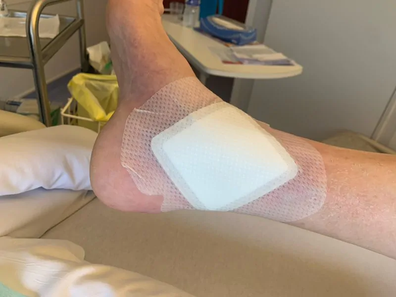 photo d'une malléole avec un pansement UrgoStart Plus Border