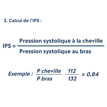 calcul de l'IPS (indice de pression systolique. IPS = pression systolique à la cheville / pression systolique au bras